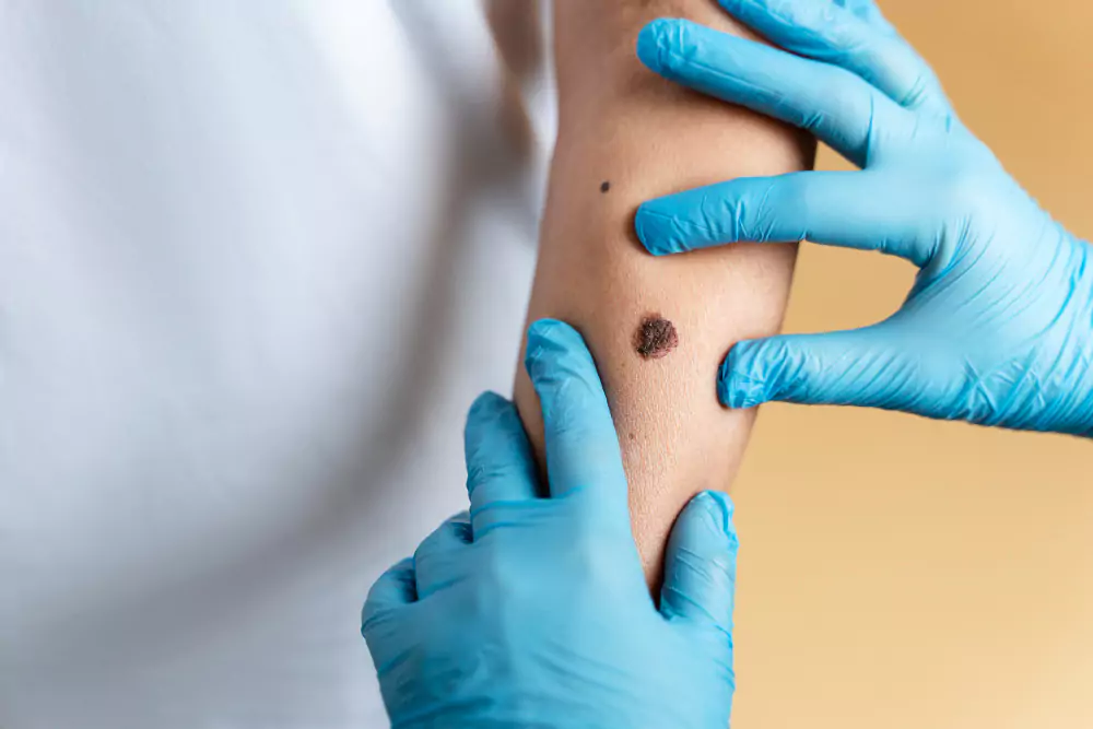 Corn, Wart & Mole Removal