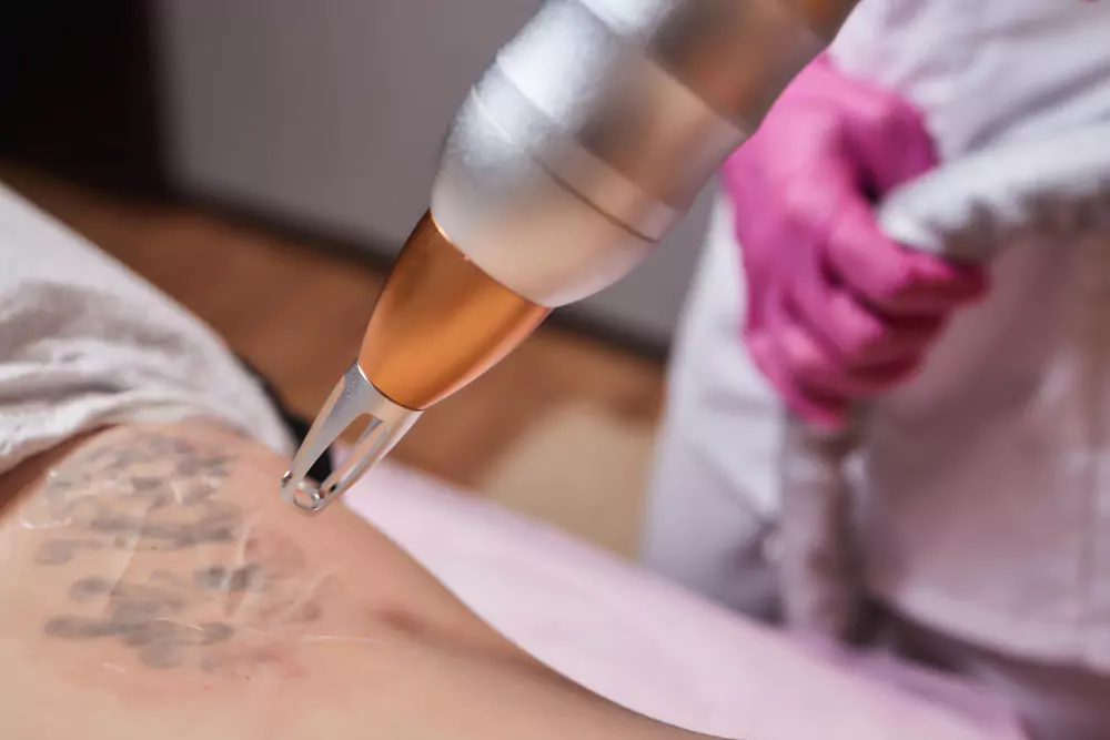 Tattoo & Birthmark Removal